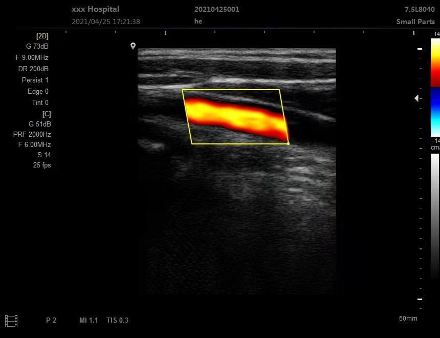 Ultrasonic color doppler Ultrasonic color doppler